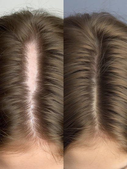 Micro-needle Hair Growth System